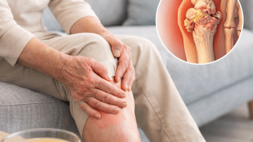 The Miracle of Rosemary for Varicose Veins: Noticeable Results After Just 1 Week